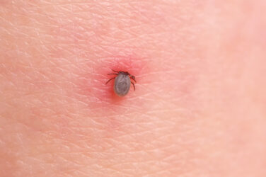 Câmara de Mogi das Cruzes aprova “Semana de Conscientização sobre a Doença de Lyme”